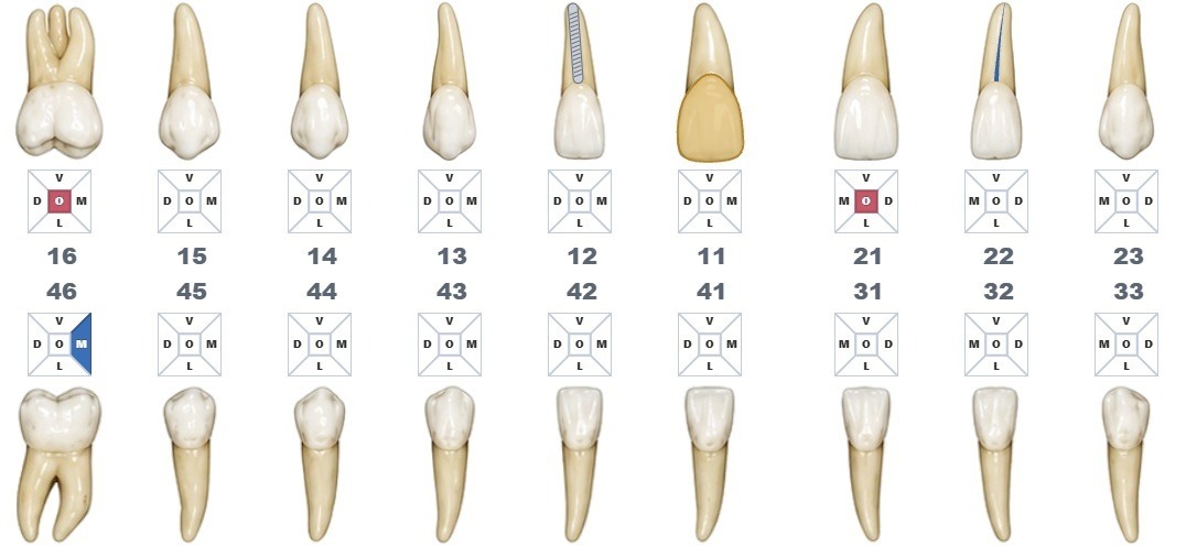 Odontograma com cárie marcada na face oclusal dos dentes 16 e 21, canal tratado no 12 e no 22, coroa protética no 11 e restauração feita na face mesial do 46.